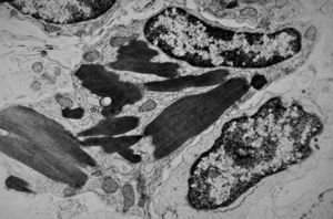 jejunum … celiakia … Charcot-Leyden crystals v.s.